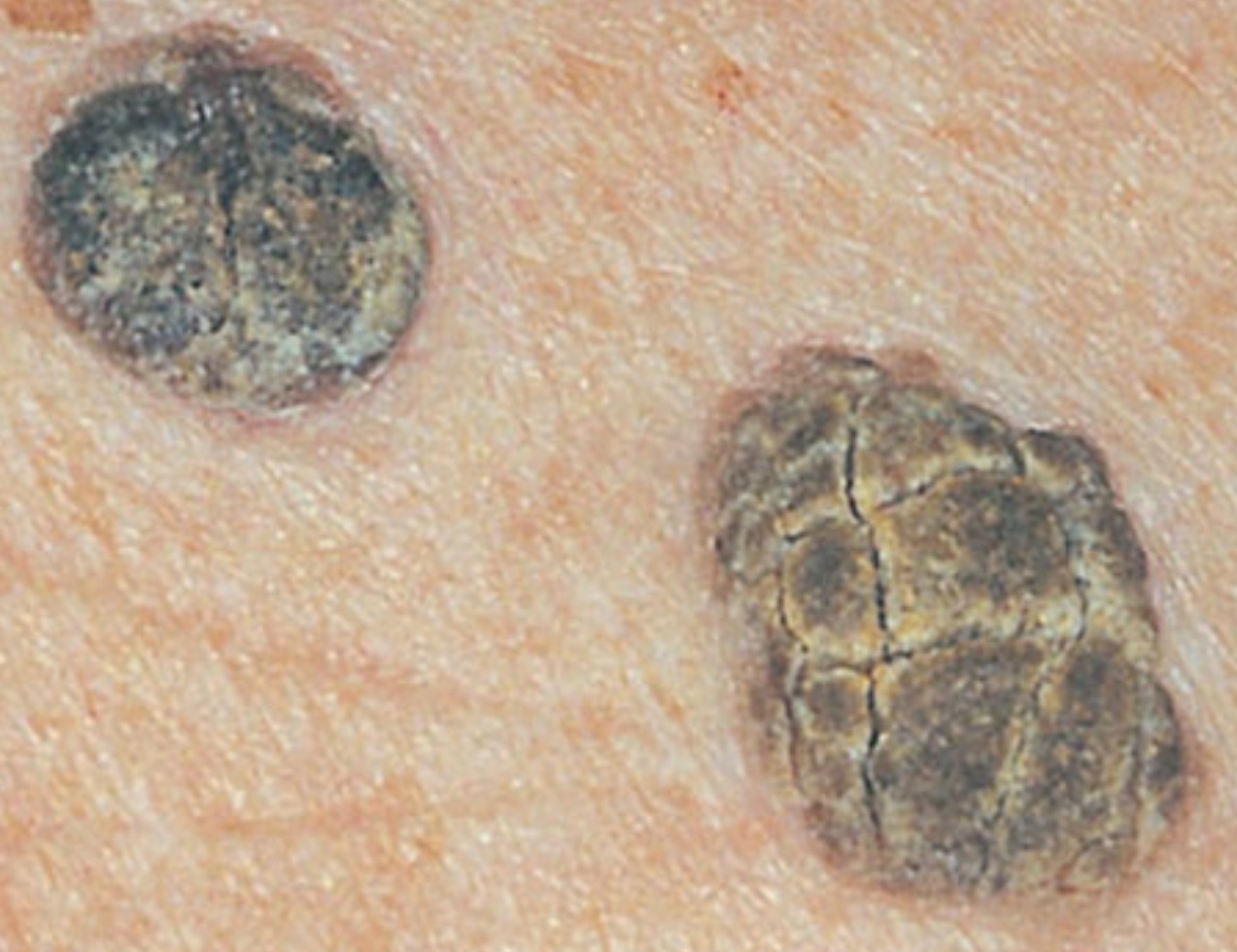 queratosis-seborreica-cl-nica-silva